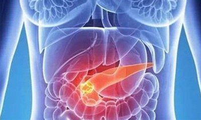 胰腺癌：沉默的“癌中之王”，了解它才能战胜它