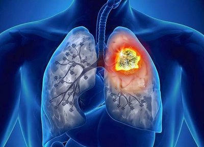 认识“头号癌症杀手”——肺癌